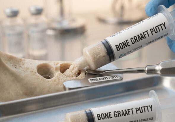 Bone graft putty